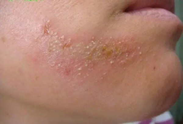 警报！厦门女大学生睡梦中脸痒挠了下，醒来进医院！这危险高发，已有人毁容