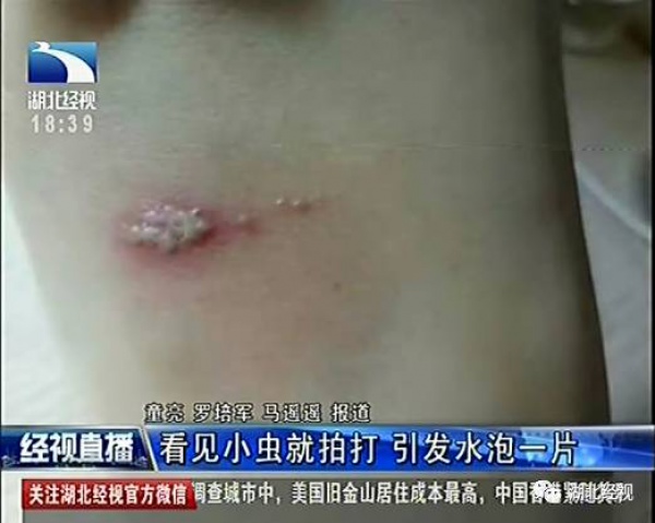 警报！厦门女大学生睡梦中脸痒挠了下，醒来进医院！这危险高发，已有人毁容