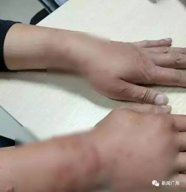 警报！厦门女大学生睡梦中脸痒挠了下，醒来进医院！这危险高发，已有人毁容