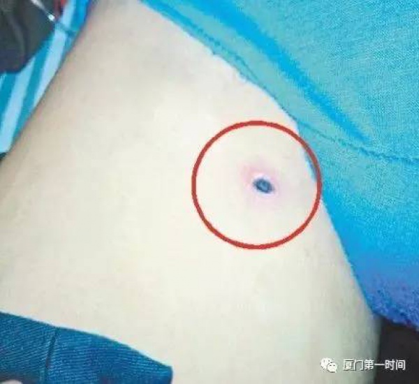 警报！厦门女大学生睡梦中脸痒挠了下，醒来进医院！这危险高发，已有人毁容