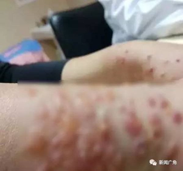 警报！厦门女大学生睡梦中脸痒挠了下，醒来进医院！这危险高发，已有人毁容