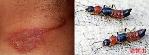 警报！厦门女大学生睡梦中脸痒挠了下，醒来进医院！这危险高发，已有人毁容