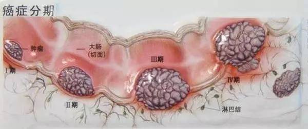 23岁女孩查出大肠癌！医生说年轻肠癌患者基本都爱吃这个……